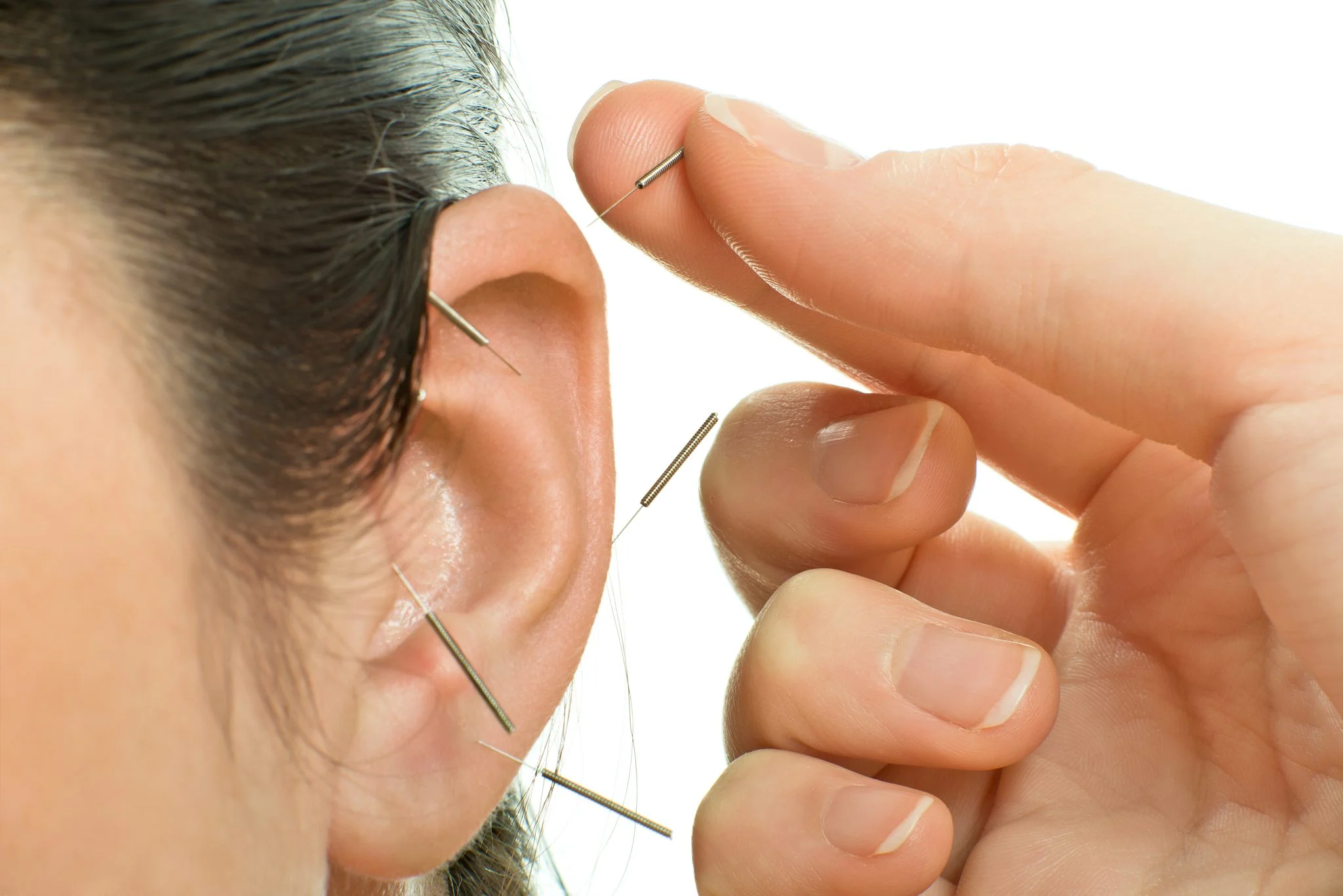 Auricular Therapy