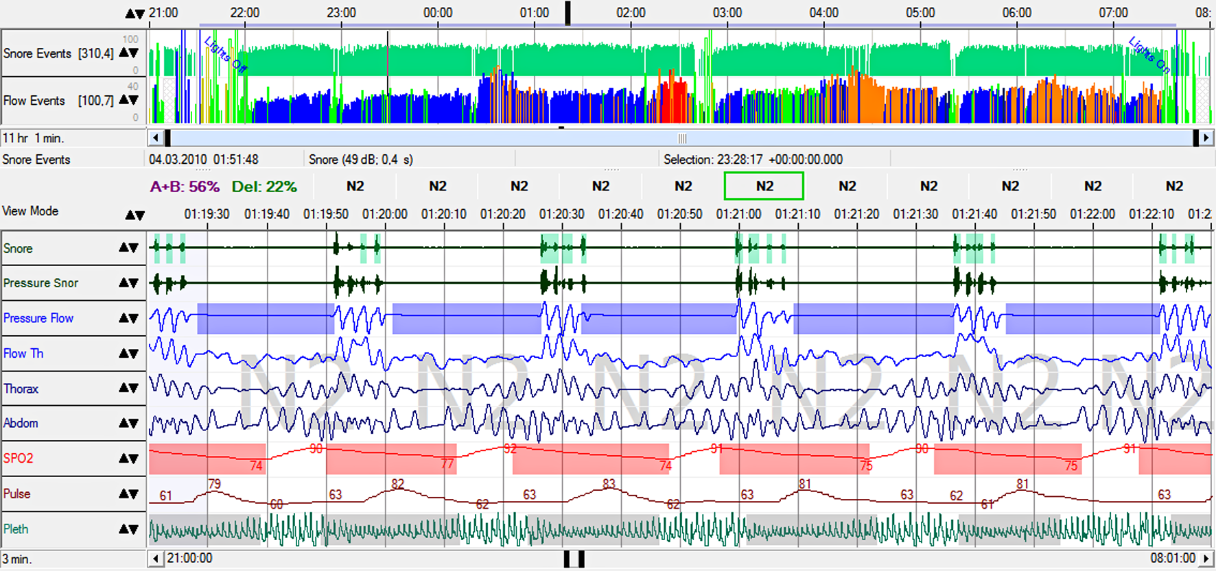 DOMINO real-time signal view with snore, pressure flow, thorax, abdomen, SpO2, pulse, and plethysmography channels