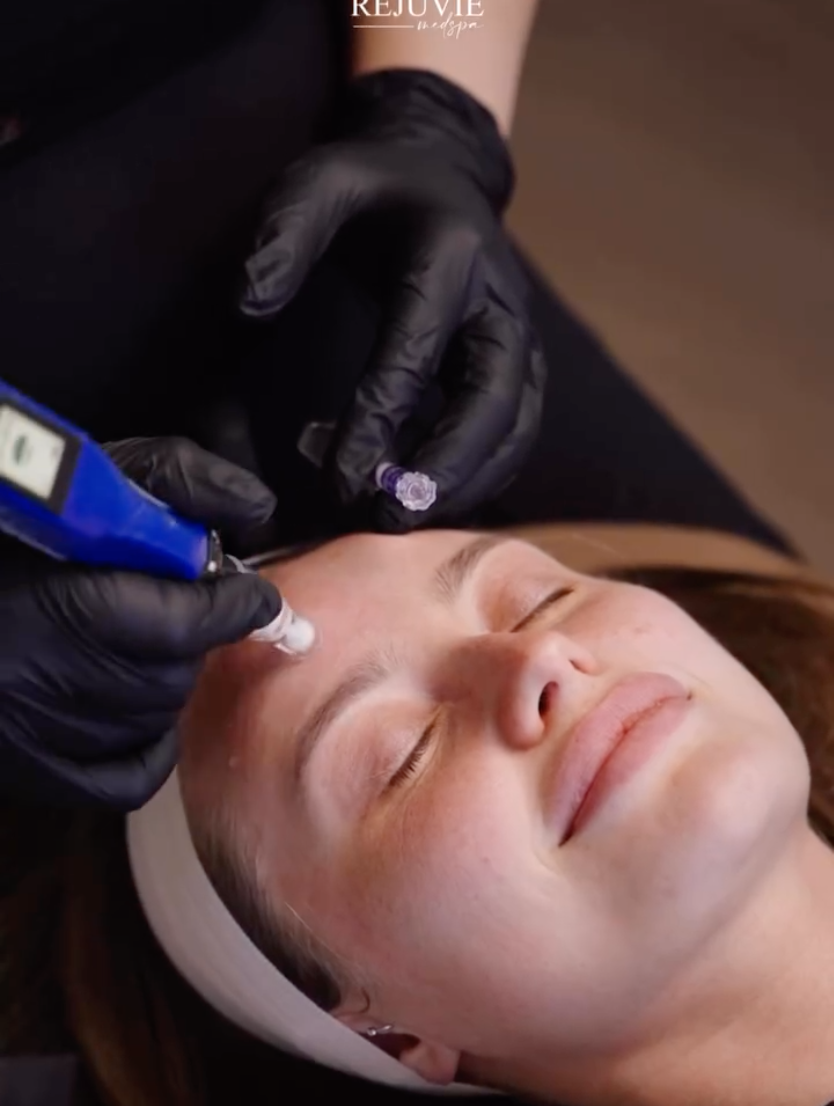 Microneedling with SkinPen