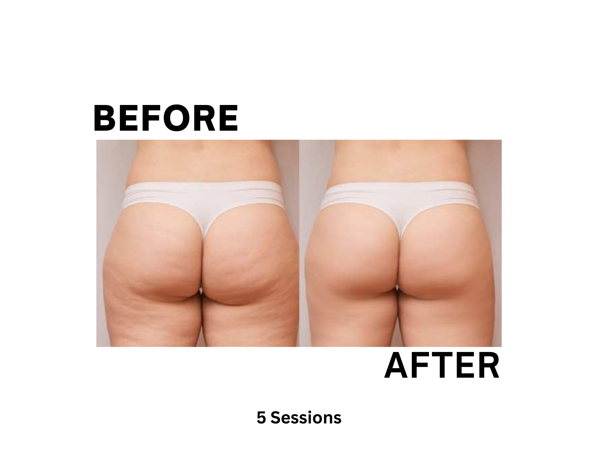 Cryotherapy before after 5 sessions