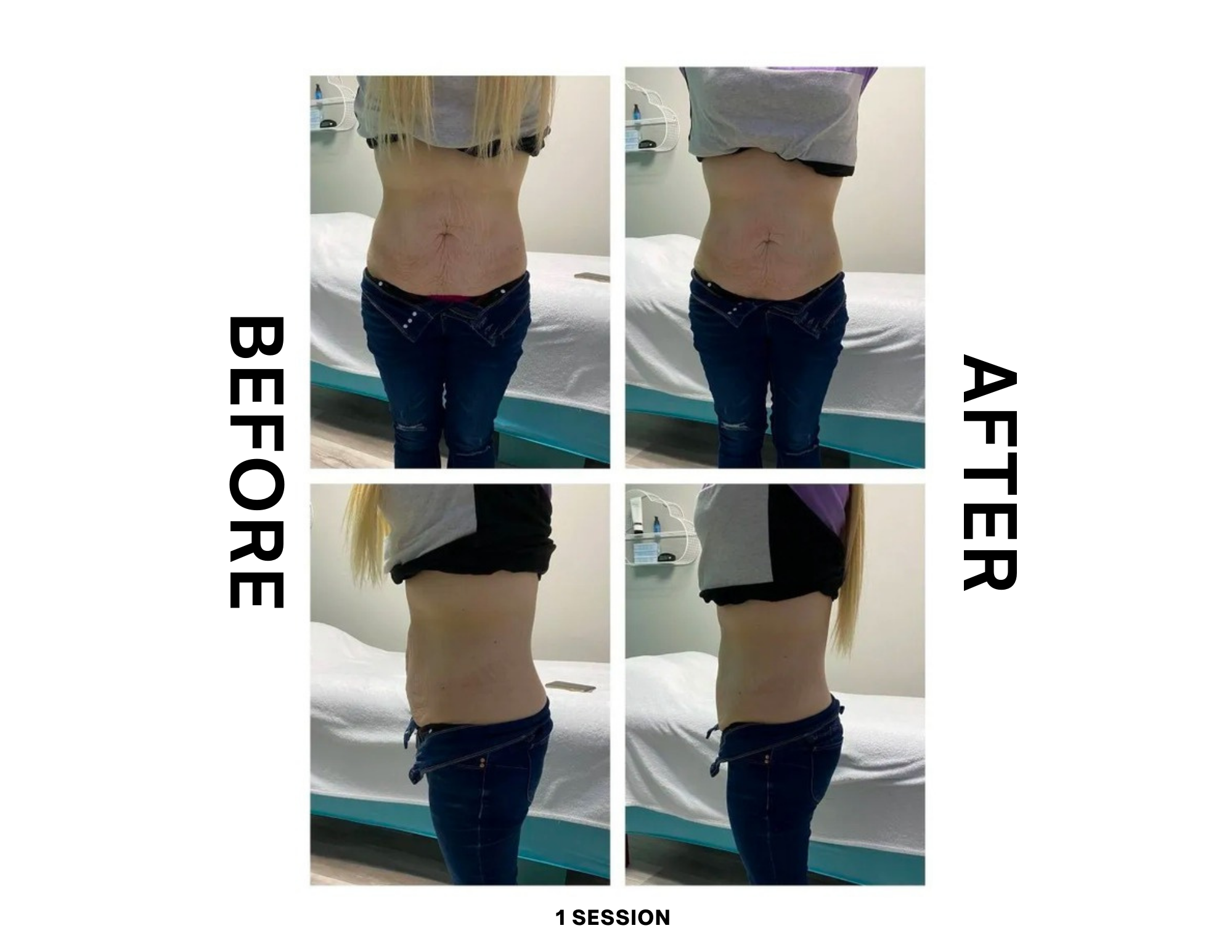 Cryotherapy before after 1 session