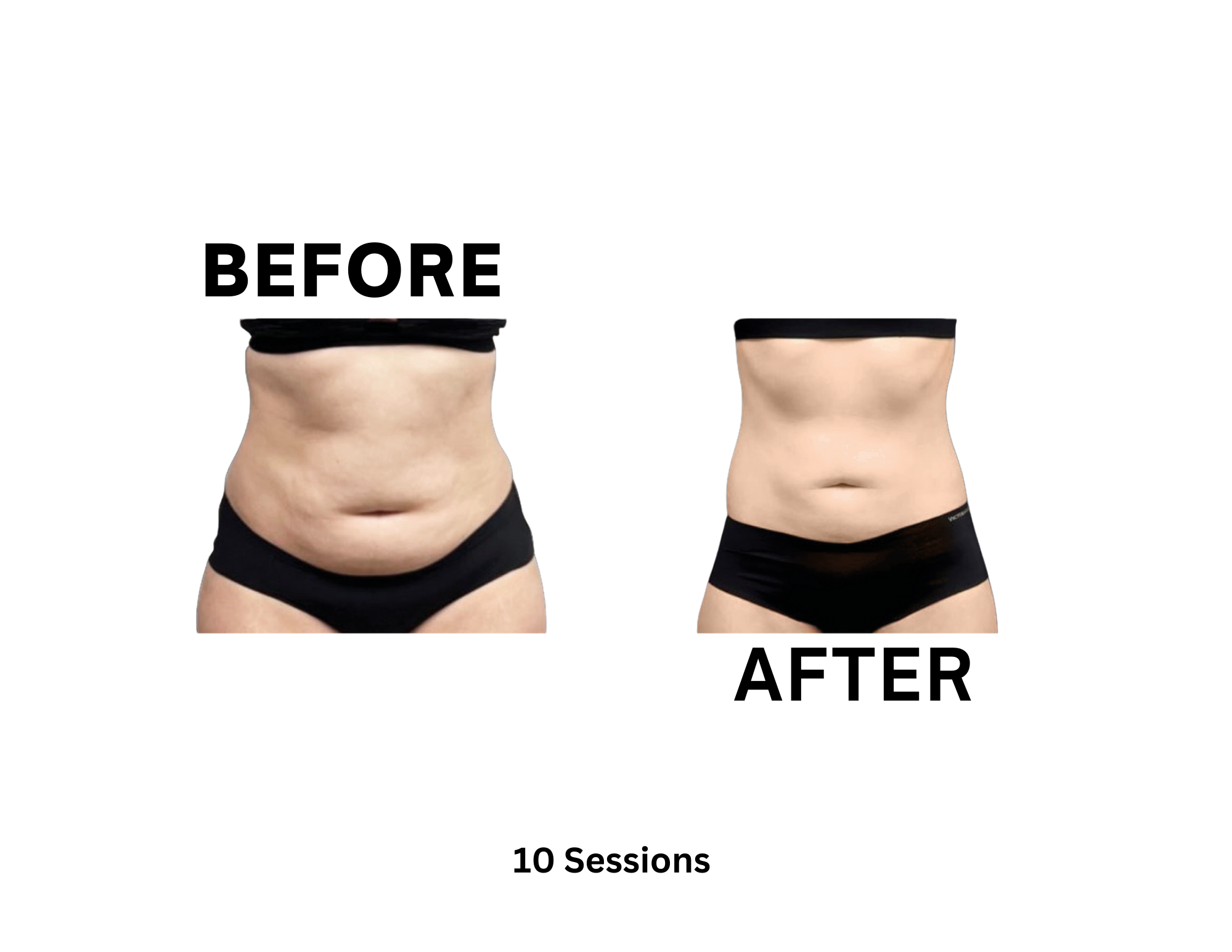 Cryotherapy before and after 10 sessions