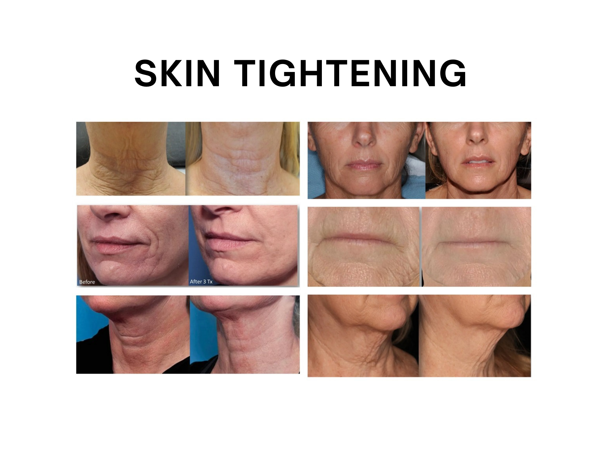 Cryotherapy Frotox skin tightening before after