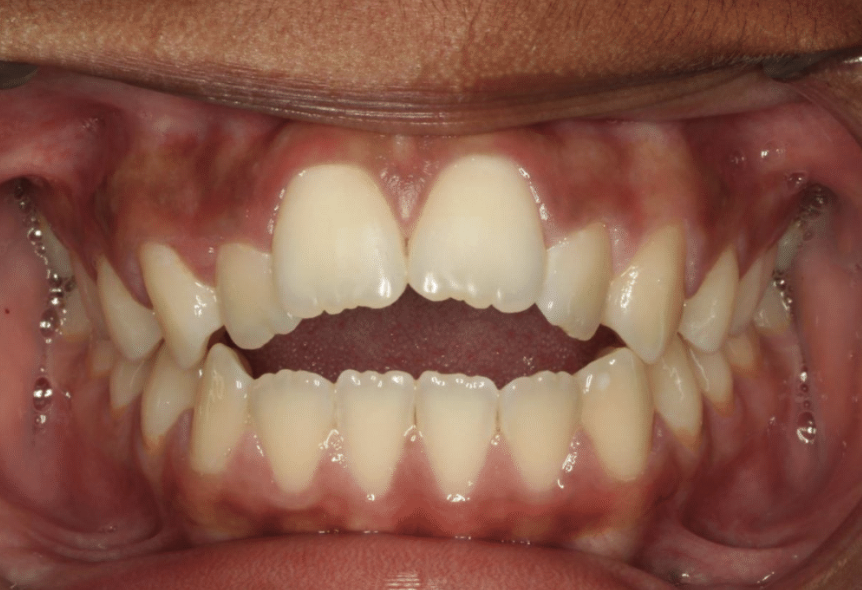Comprehensive open bite – Patient 3 before