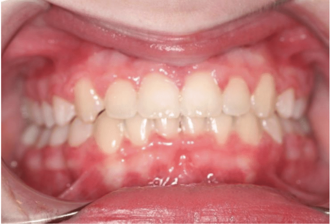 Digit habit – Patient 4 after