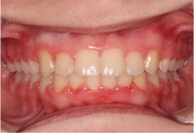 Comprehensive protrusion – Patient 5 after