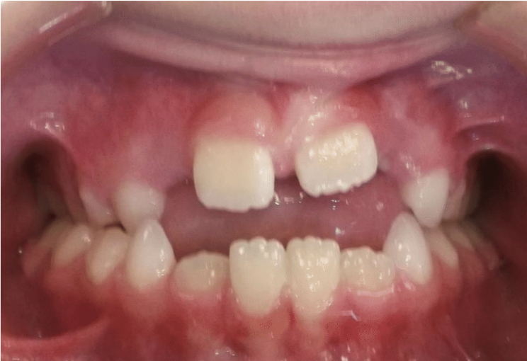 Digit habit – Patient 7 before