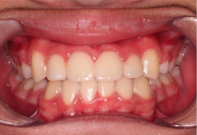 Comprehensive underbite – Patient 6 after
