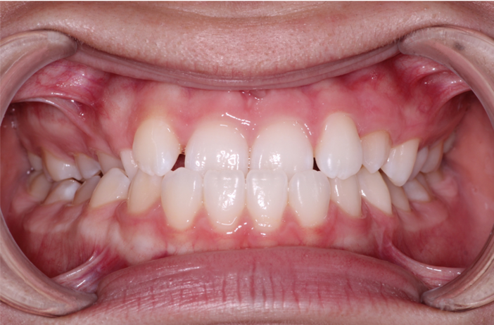Comprehensive underbite – Patient 7 before