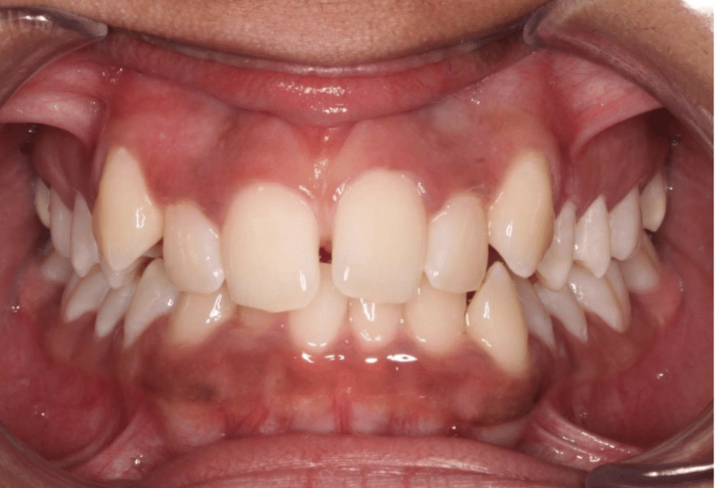 Comprehensive crowding – Patient 8 before