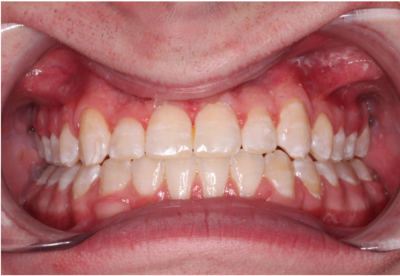 Comprehensive underbite – Patient 1 after