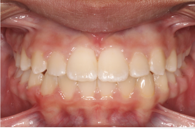 Crossbite correction – Patient 3 after