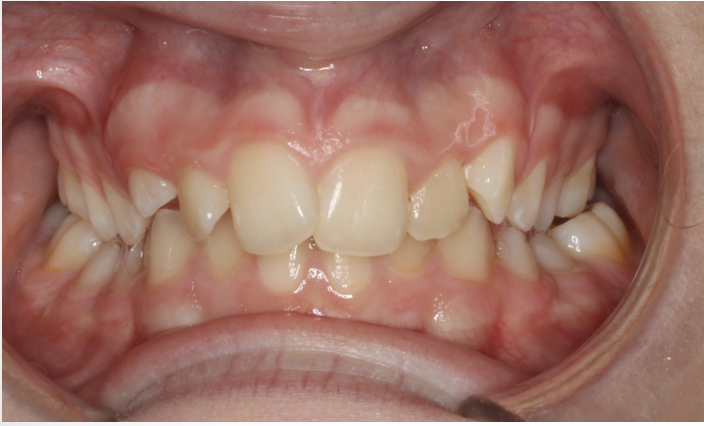 Crossbite correction – Patient 6 before