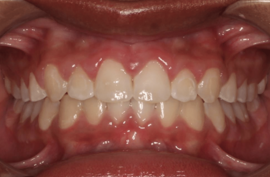 Comprehensive spacing – Patient 1 after