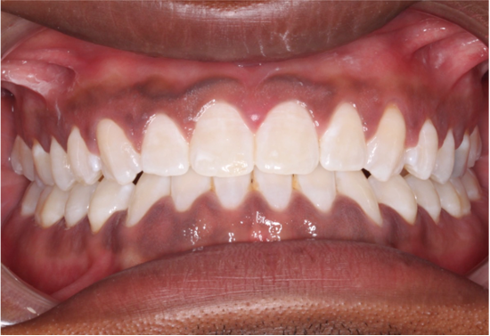 Comprehensive underbite – Patient 2 after