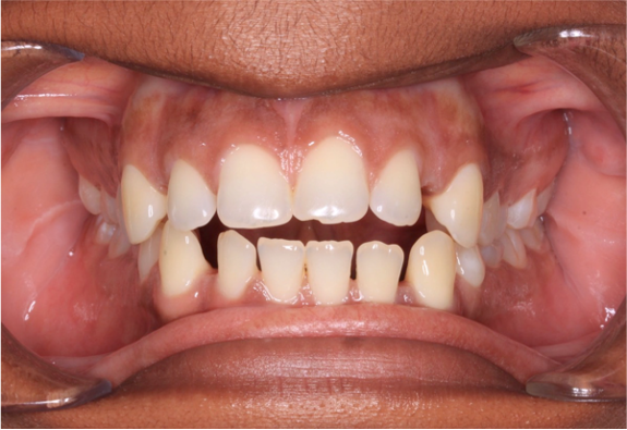 Comprehensive open bite – Patient 2 before
