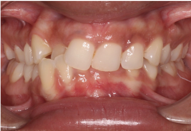 Crossbite correction – Patient 7 before