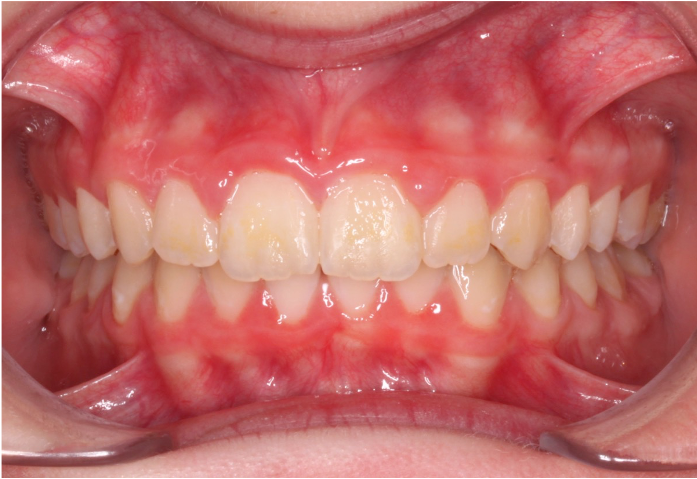 Comprehensive protrusion – Patient 3 after