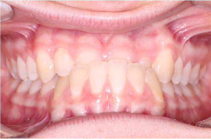 Comprehensive underbite – Patient 8 before