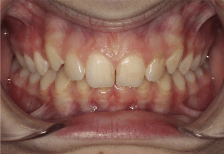 Comprehensive deep bite – Patient 6 before