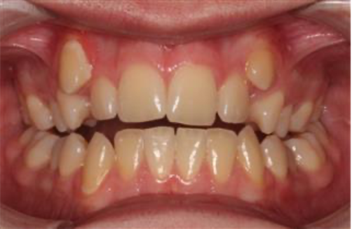 Comprehensive open bite – Patient 7 before