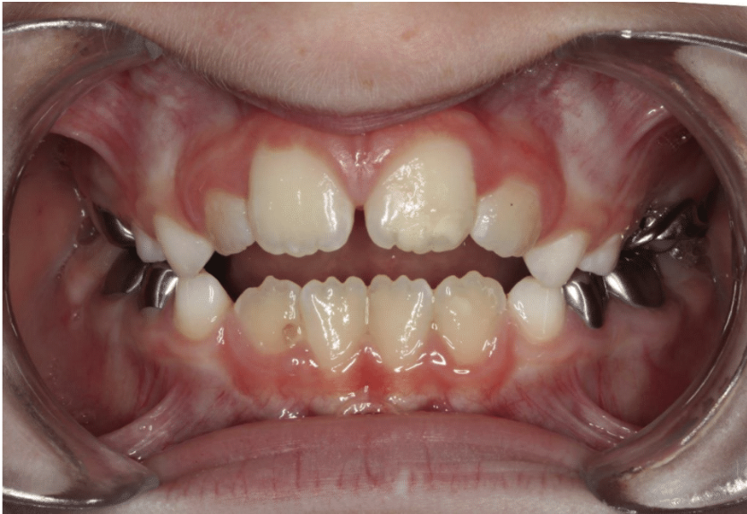 Digit habit – Patient 6 before