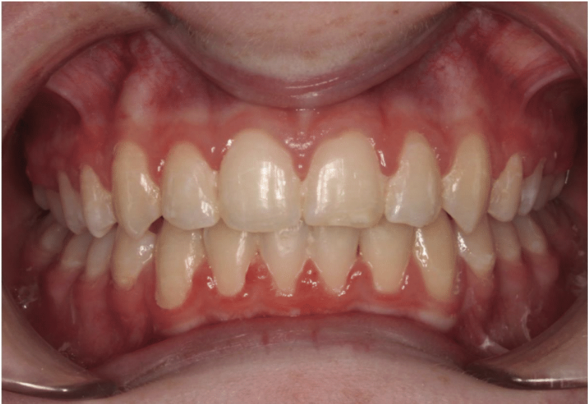 Digit habit – Patient 6 after