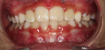 Phase I underbite – Patient 6 after