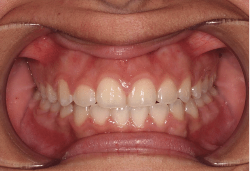 Comprehensive crowding – Patient 7 after