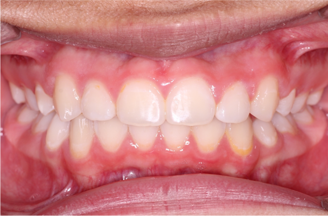 Comprehensive protrusion – Patient 8 after