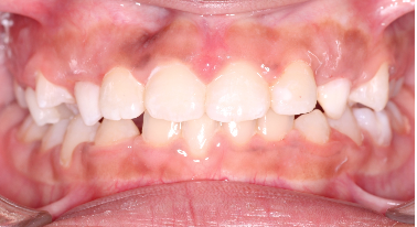 Phase I underbite – Patient 8 after