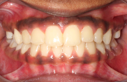 After treatment