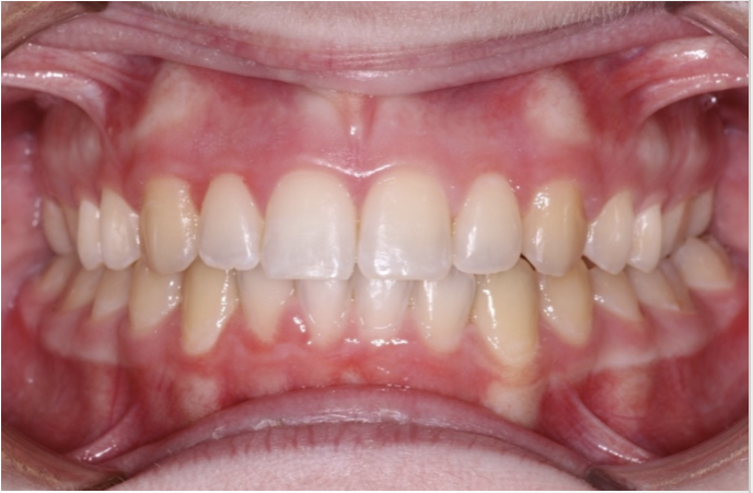 Crossbite correction – Patient 5 after