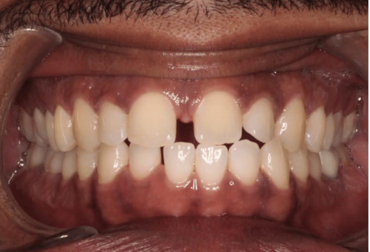 Comprehensive spacing – Patient 7 before