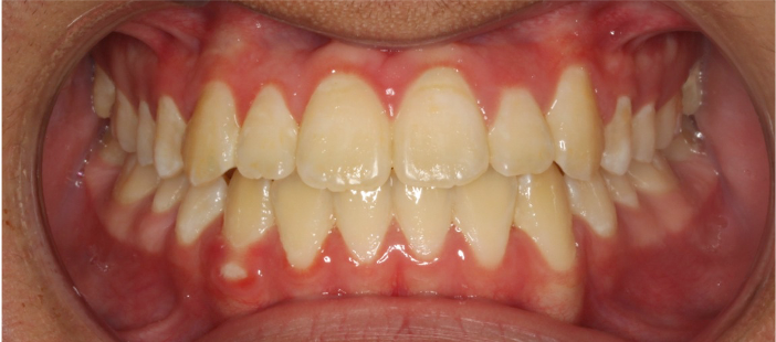 Comprehensive underbite – Patient 3 after