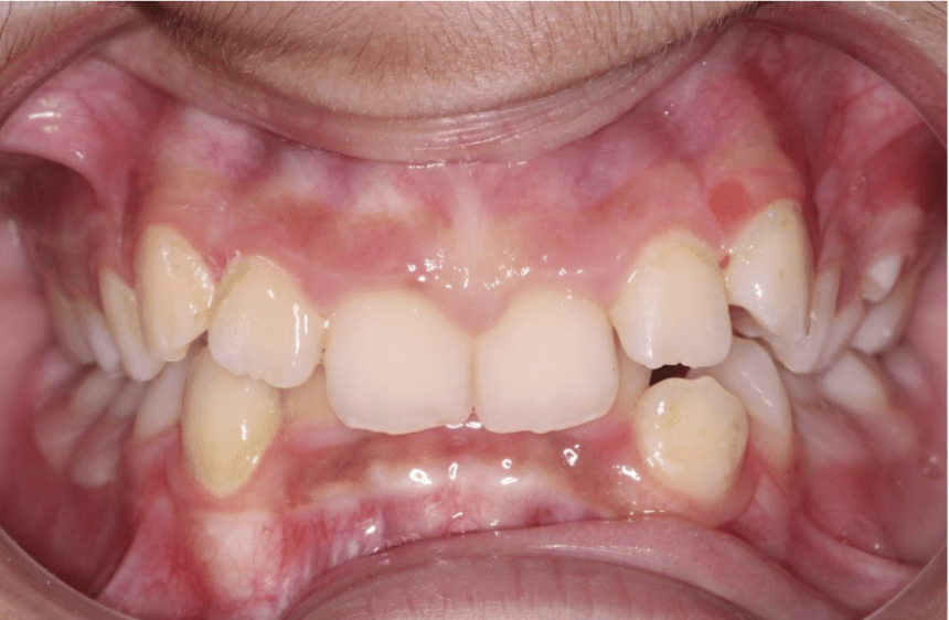 Comprehensive crowding – Patient 3 before
