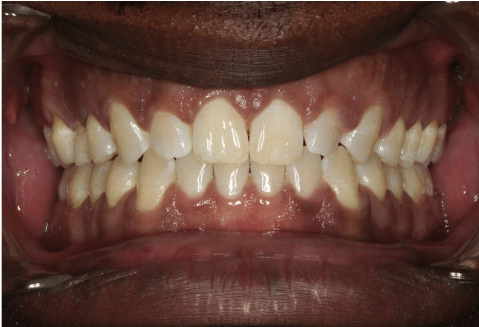 Comprehensive spacing – Patient 4 after