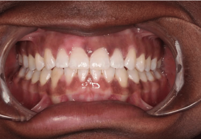 Comprehensive spacing – Patient 5 after