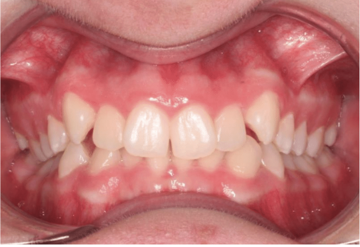 Comprehensive crowding – Patient 1 before