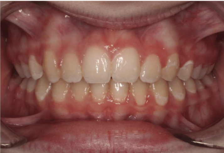 Comprehensive deep bite – Patient 6 after