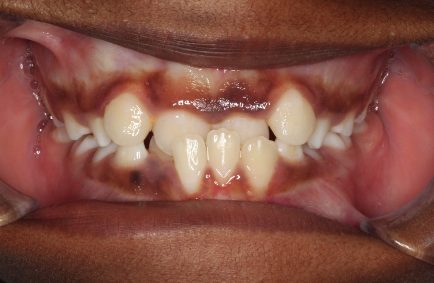 Phase I underbite – Patient 1 before