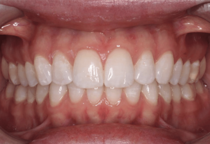 Comprehensive deep bite – Patient 2 after
