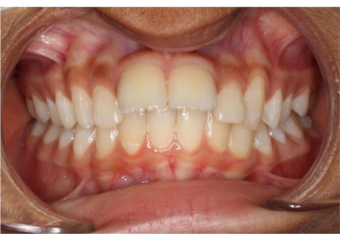 Comprehensive protrusion – Patient 1 before