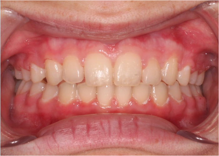 Comprehensive protrusion – Patient 6 after