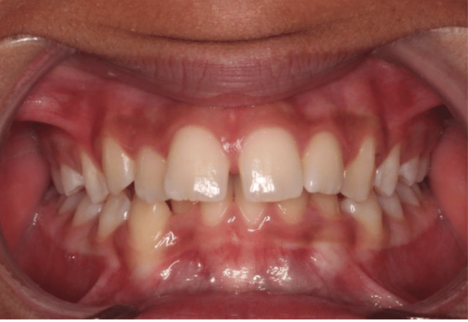 Comprehensive deep bite – Patient 1 before
