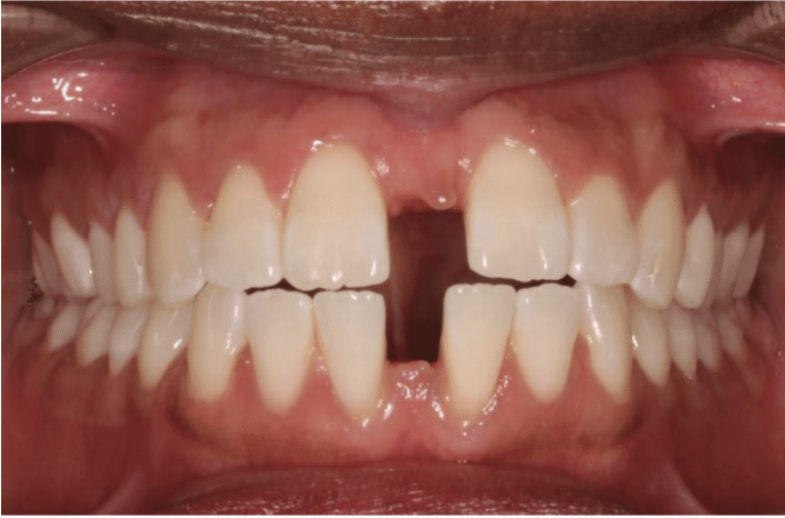 Comprehensive spacing – Patient 2 before