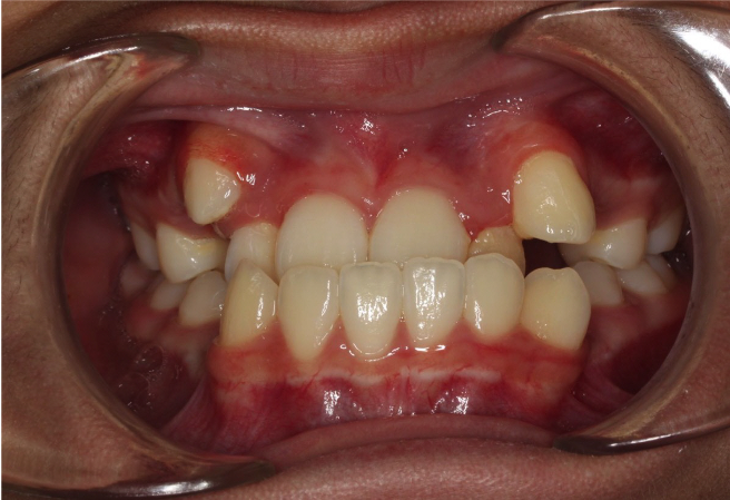 Comprehensive underbite – Patient 6 before