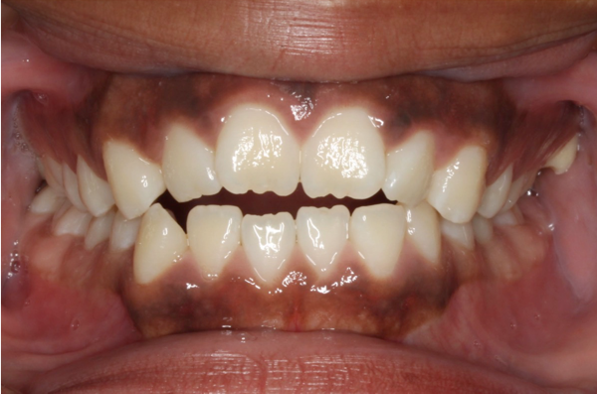 Comprehensive open bite – Patient 1 before