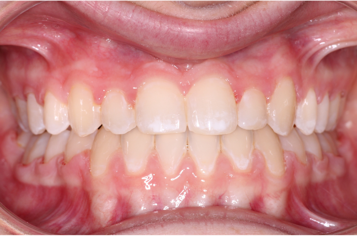 Comprehensive underbite – Patient 8 after
