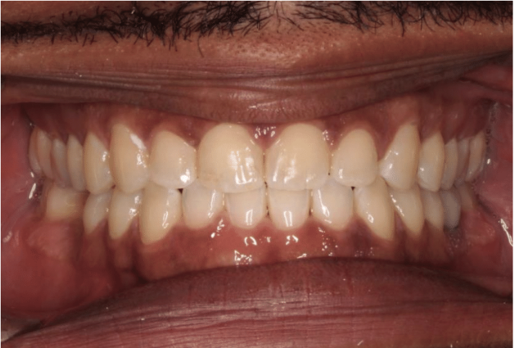Comprehensive spacing – Patient 7 after